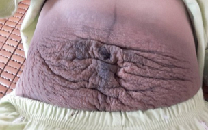 Bà mẹ 24 tuổi chia sẻ "vết tích" bụng rạn 13 ngày sau sinh nhìn đến xót xa